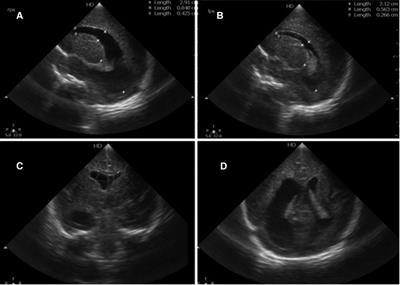 Case Report: Occlusion of the foramen of Monro treated with endoscopic septostomy and foraminotomy in a preterm neonate